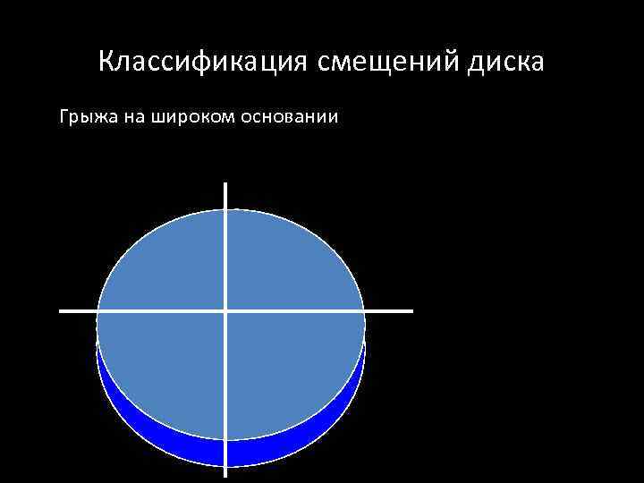 Классификация смещений диска Грыжа на широком основании 