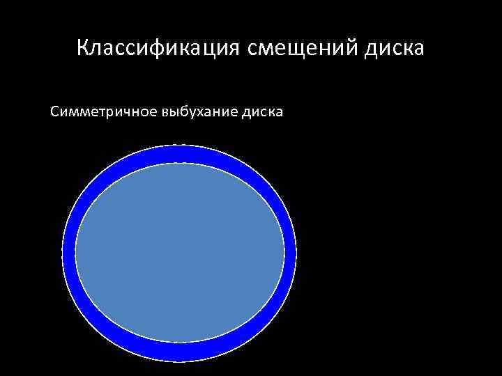 Классификация смещений диска Симметричное выбухание диска 