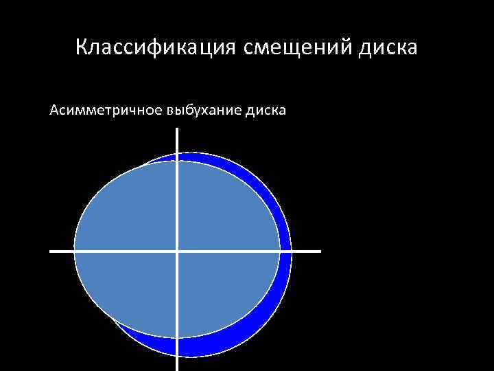 Классификация смещений диска Асимметричное выбухание диска 