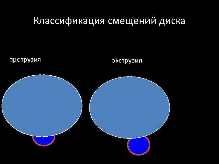 Классификация смещений диска протрузия экструзия 