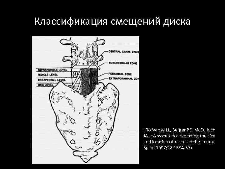 Классификация смещений диска (По Wiltse LL, Berger PE, Mc. Culloch JA. «A system for