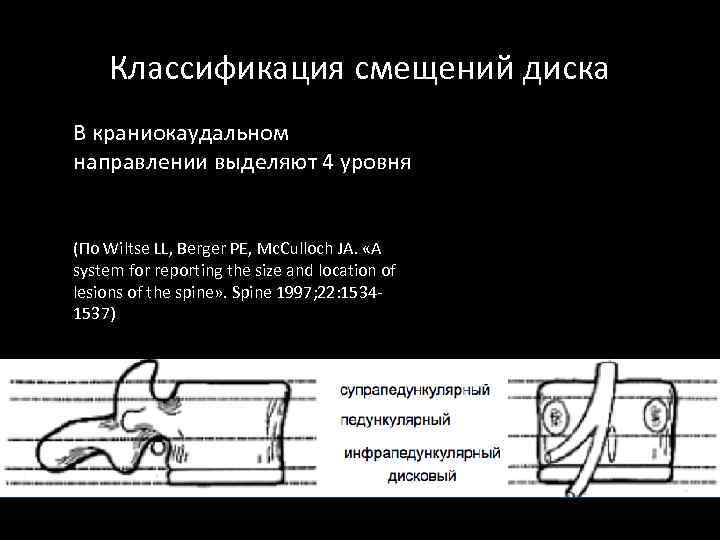 Классификация смещений диска В краниокаудальном направлении выделяют 4 уровня (По Wiltse LL, Berger PE,