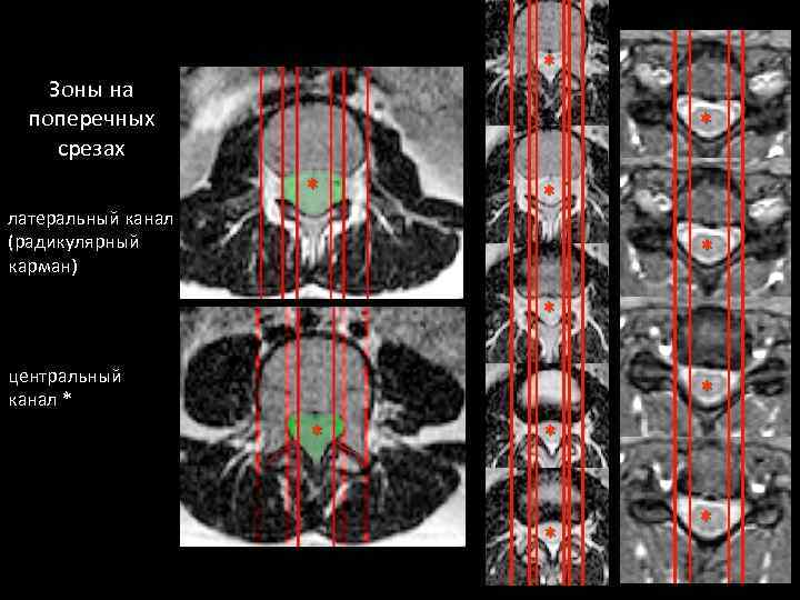 * Зоны на поперечных срезах * * латеральный канал (радикулярный карман) * * *