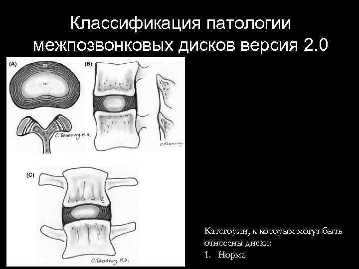 Классификация патологии межпозвонковых дисков версия 2. 0 Категории, к которым могут быть отнесены диски: