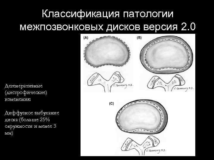 Классификация патологии межпозвонковых дисков версия 2. 0 Дегенеративные (дистрофические) изменения: Диффузное выбухание диска (больше