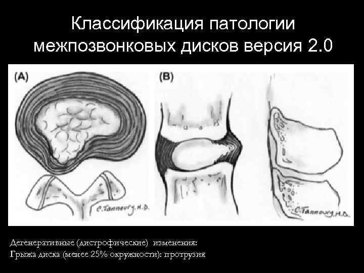 Классификация патологии межпозвонковых дисков версия 2. 0 Дегенеративные (дистрофические) изменения: Грыжа диска (менее 25%