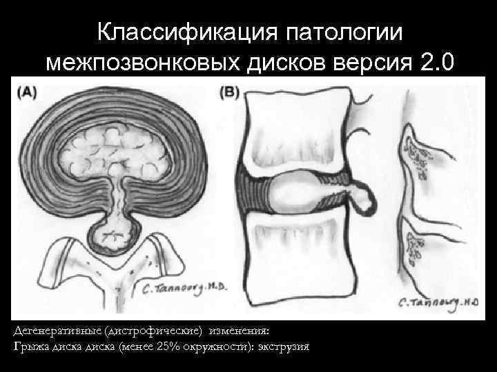 Экструзия диска. Экструзия дисков l3-l4. Экструзии дисков l3-s1. Экструзия диска l2-l3 что это такое. Парацентральная экструзия диска.