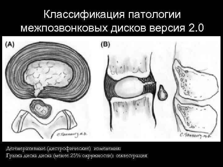 Классификация патологии межпозвонковых дисков версия 2. 0 Дегенеративные (дистрофические) изменения: Грыжа диска (менее 25%