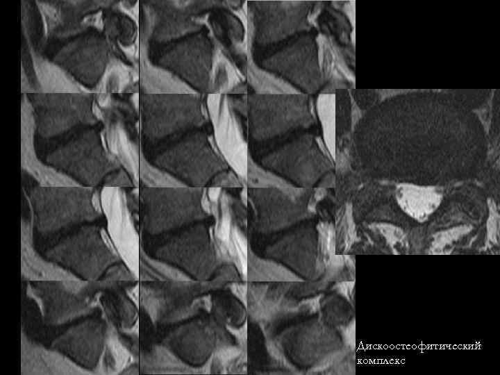 Дискоостеофитический комплекс 