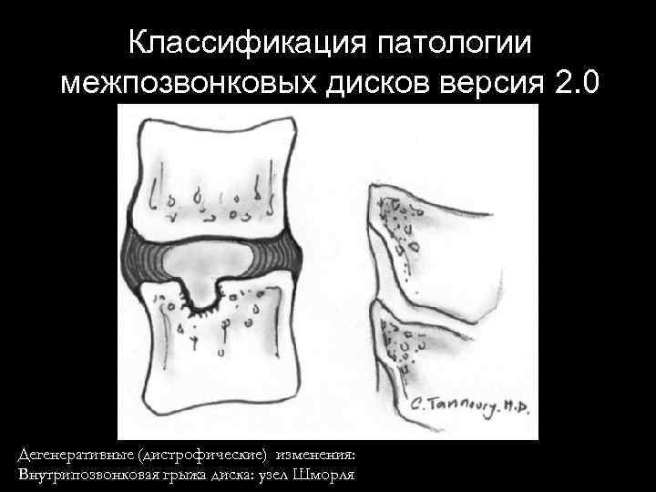 Классификация патологии межпозвонковых дисков версия 2. 0 Дегенеративные (дистрофические) изменения: Внутрипозвонковая грыжа диска: узел