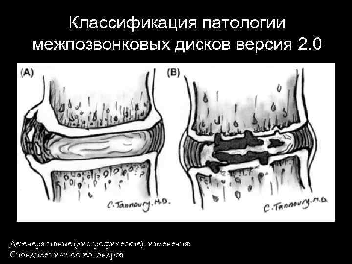 Классификация патологии межпозвонковых дисков версия 2. 0 Дегенеративные (дистрофические) изменения: Спондилез или остеохондроз 