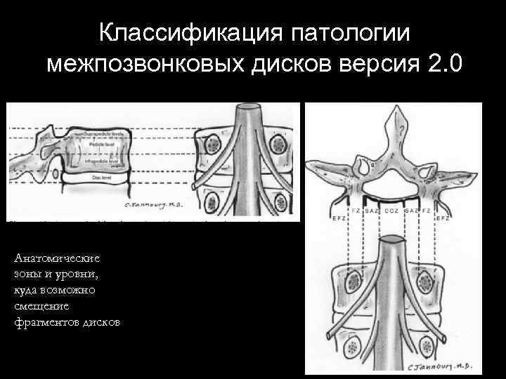 Классификация патологии межпозвонковых дисков версия 2. 0 Анатомические зоны и уровни, куда возможно смещение