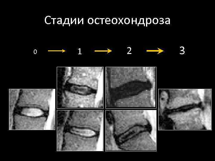 Стадии остеохондроза 0 1 2 3 