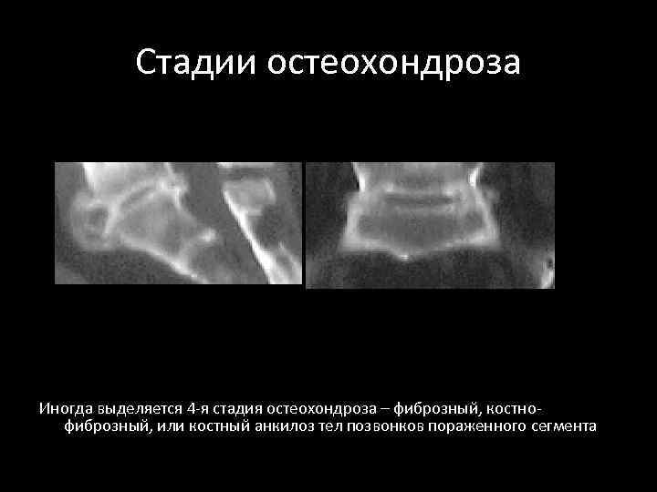 Стадии остеохондроза Иногда выделяется 4 -я стадия остеохондроза – фиброзный, костнофиброзный, или костный анкилоз