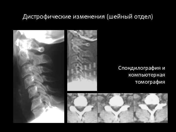 Дистрофические изменения. Спондилография поясничного отдела позвоночника. Функциональная спондилография шейного отдела позвоночника. Рентгенография позвоночника (спондилография). Функциональная спондилография поясничного отдела.