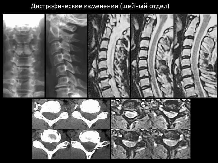 Дистрофические изменения (шейный отдел) 