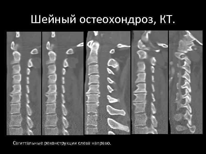 Шейный остеохондроз, КТ. Сагиттальные реконструкции слева направо. 