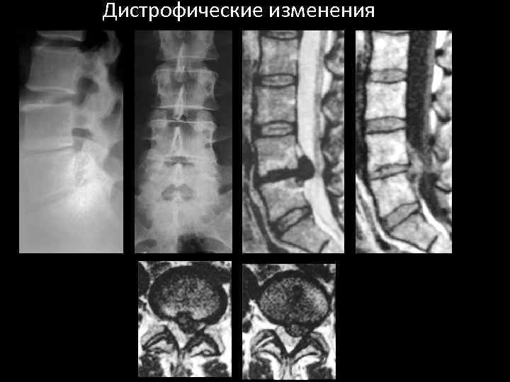 Дистрофические изменения 