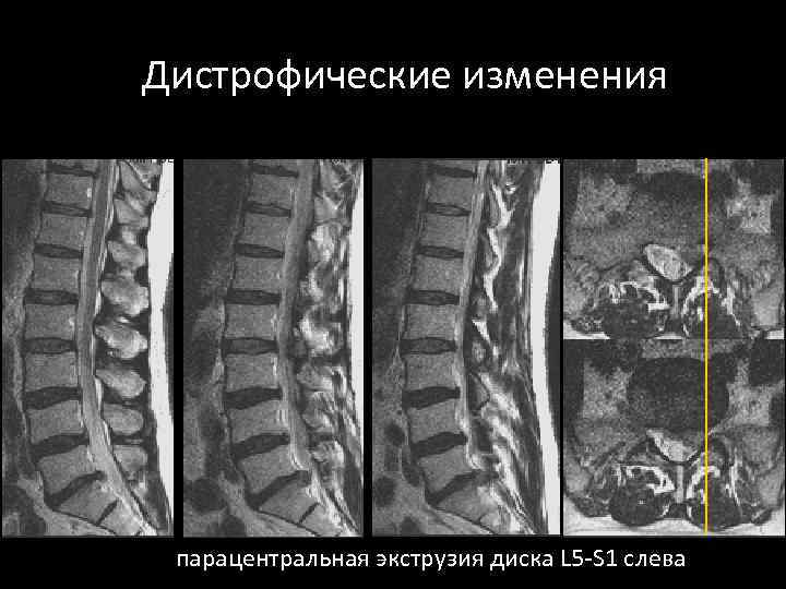 Дистрофические изменения парацентральная экструзия диска L 5 -S 1 слева 