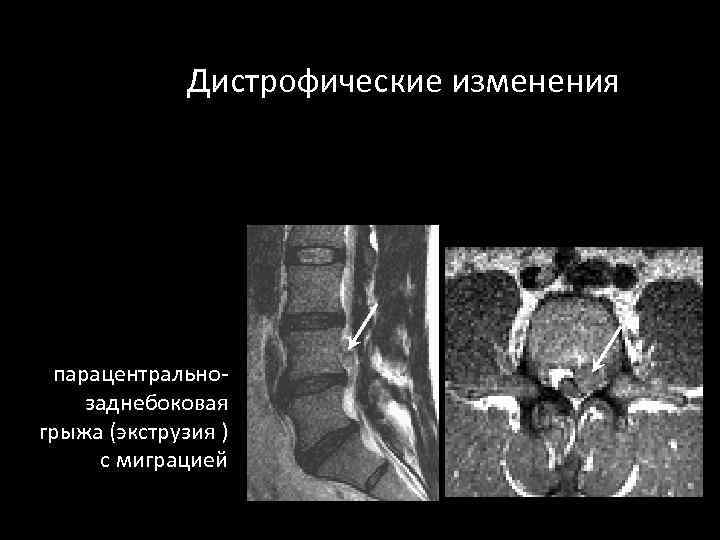 Дистрофические изменения парацентральнозаднебоковая грыжа (экструзия ) с миграцией 