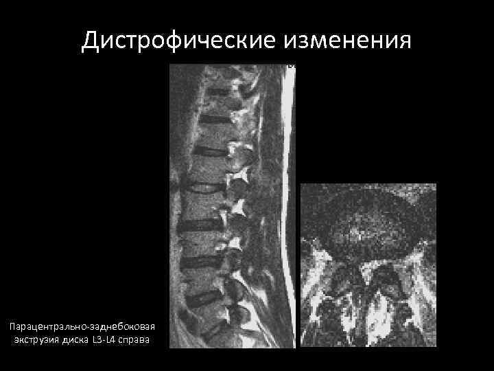 Дистрофические изменения Парацентрально-заднебоковая экструзия диска L 3 -L 4 справа 