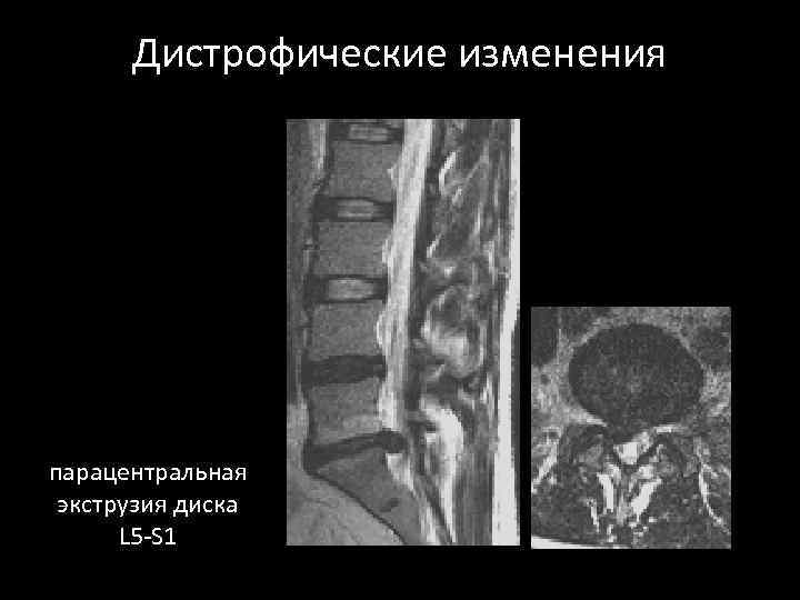 Дистрофические изменения парацентральная экструзия диска L 5 -S 1 