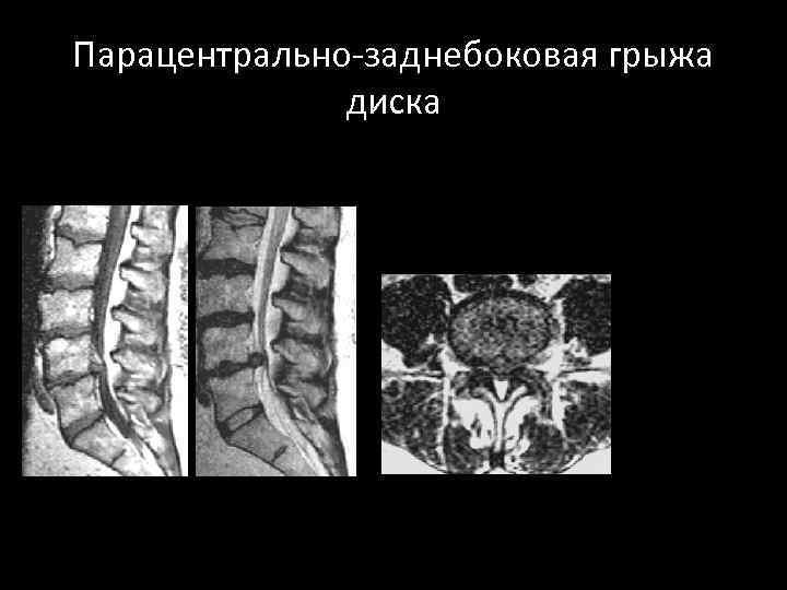 Парацентрально-заднебоковая грыжа диска 