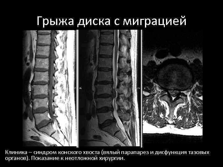 Экструзия с каудальной миграцией