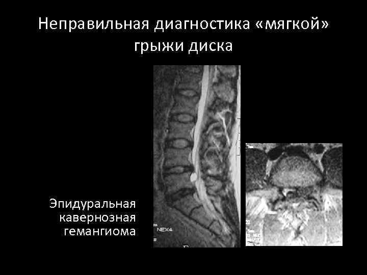 Неправильная диагностика «мягкой» грыжи диска Эпидуральная кавернозная гемангиома 