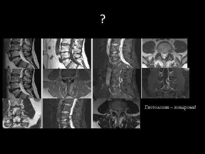 ? Гистология – хондрома! 