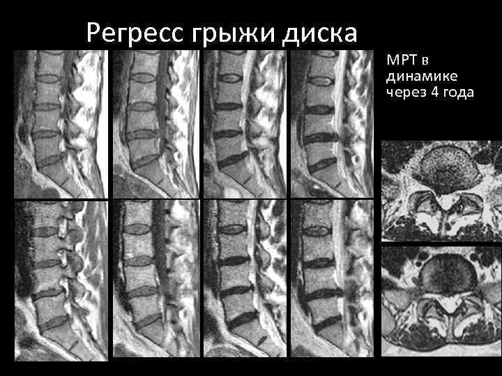 Регресс грыжи диска МРТ в динамике через 4 года 