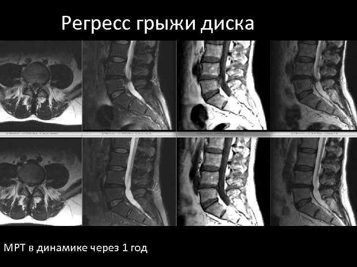 Регресс грыжи диска МРТ в динамике через 1 год 