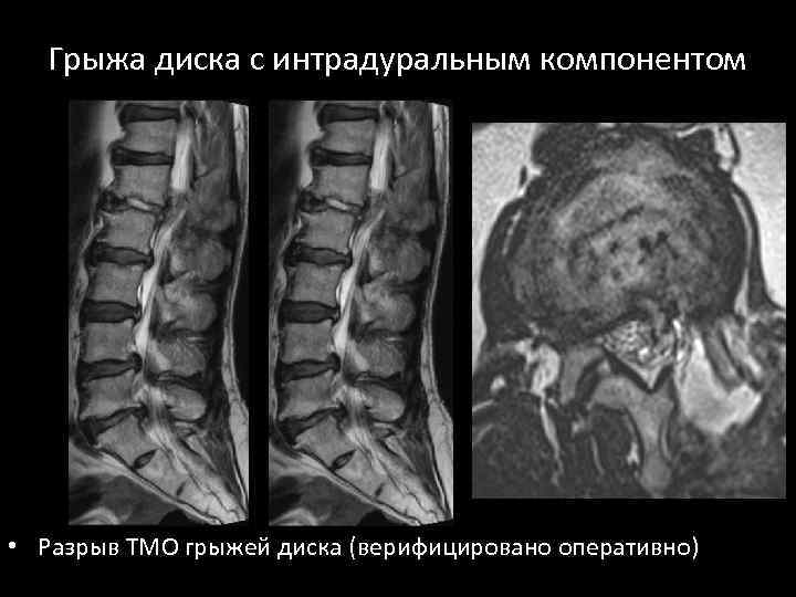 Грыжа диска с интрадуральным компонентом • Разрыв ТМО грыжей диска (верифицировано оперативно) 