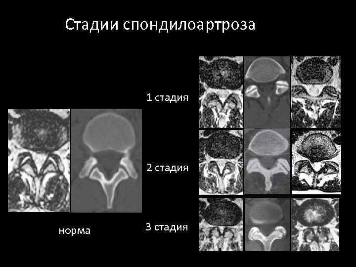 Стадии спондилоартроза 1 стадия 2 стадия норма 3 стадия 