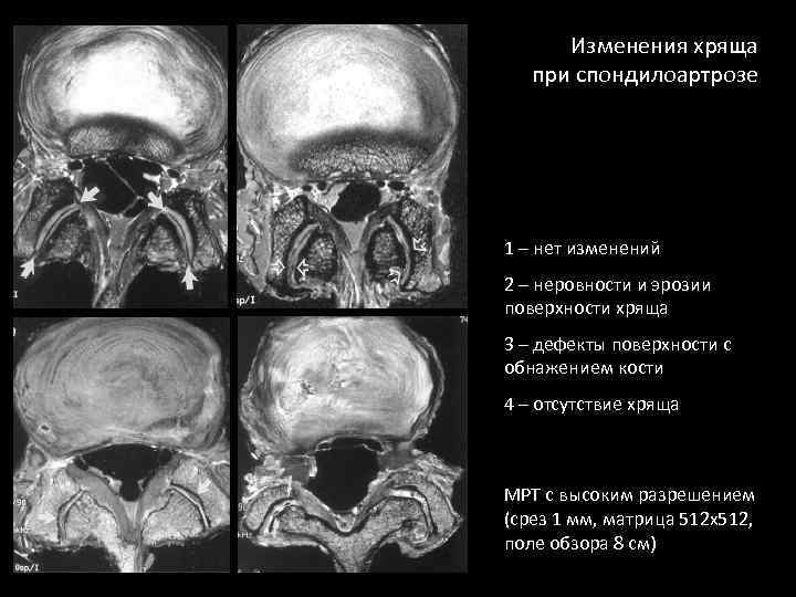 Изменения хряща при спондилоартрозе 1 – нет изменений 2 – неровности и эрозии поверхности