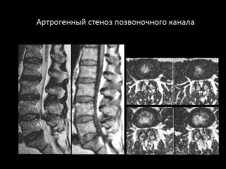 Артрогенный стеноз позвоночного канала 