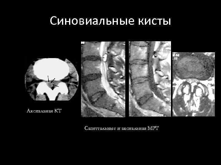 Синовиальные кисты Аксиальная КТ Сагиттальные и аксиальная МРТ 