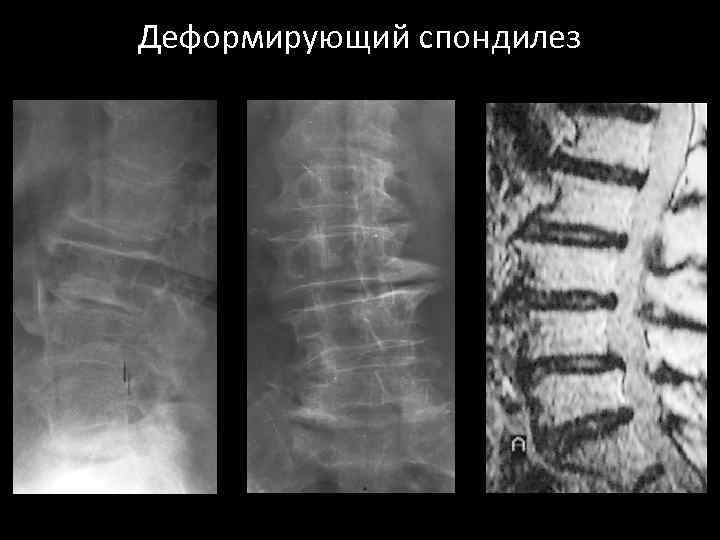 Деформирующий спондилез позвоночника лечение