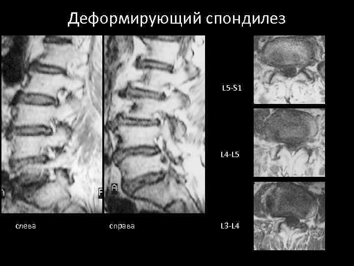 Деформирующий спондилез L 5 -S 1 L 4 -L 5 слева справа L 3