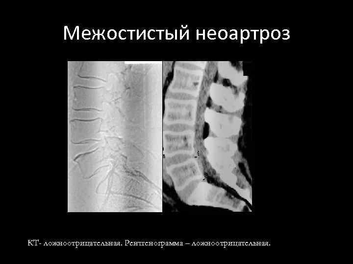 Межостистый неоартроз КТ- ложноотрицательная. Рентгенограмма – ложноотрицательная. 