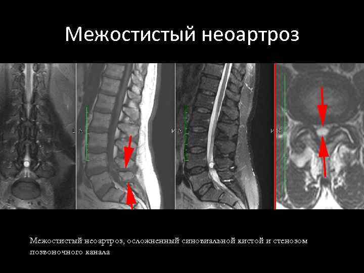 Межостистый неоартроз, осложненный синовиальной кистой и стенозом позвоночного канала 