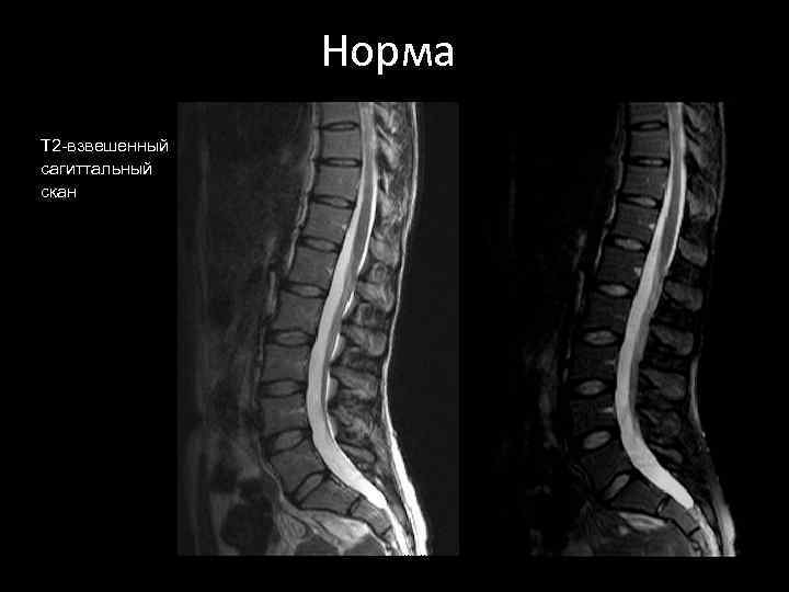 Норма T 2 -взвешенный сагиттальный скан 