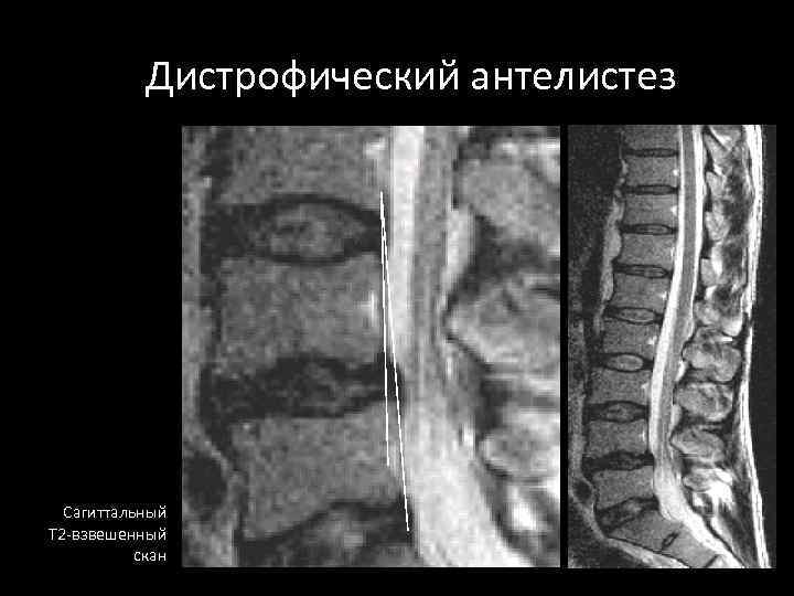 Антелистез позвонка