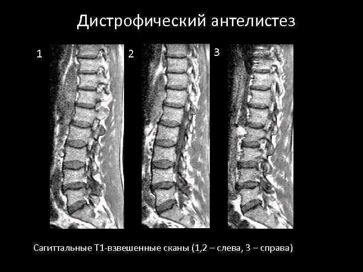 Дистрофический антелистез 1 2 3 Сагиттальные Т 1 -взвешенные сканы (1, 2 – слева,