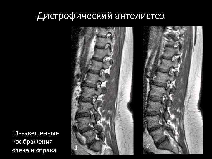 Антелистез позвонка