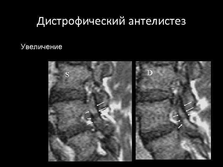 Дистрофический антелистез Увеличение S D 