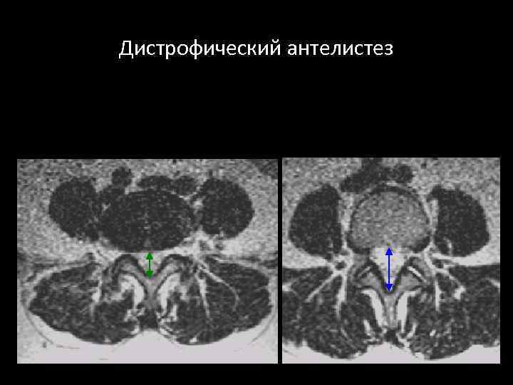 Дистрофический антелистез 