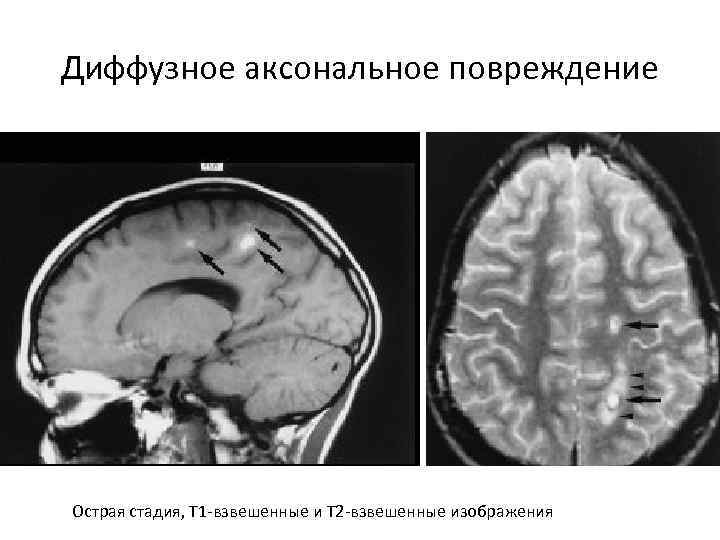 Диффузное аксональное повреждение мозга