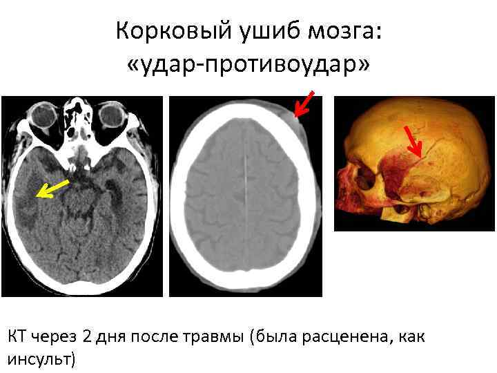Удар мозга. Ударно-противоударная ЧМТ. Противоудар головного мозга. Противоударные повреждения головного мозга. Типы ушибов головного мозга.