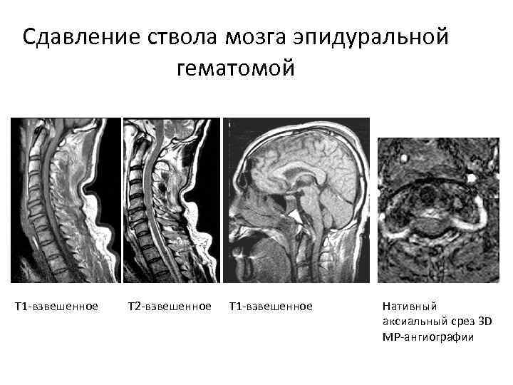 Сдавление головного мозга гематомой